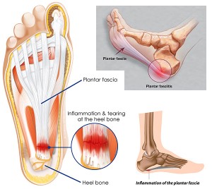 plantar-fasciitis-01