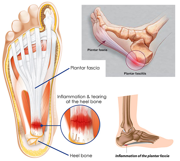 Heel on sale stabbing pain